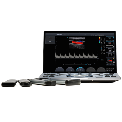 УЗИ аппарат Chison SonoAir 60 - 600 000 руб.